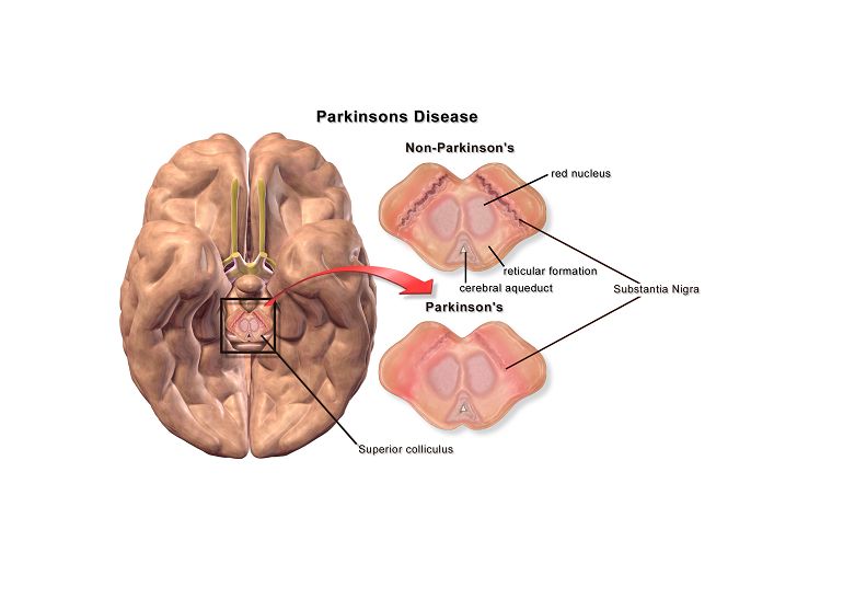 Blausen 0704 Parkinsonsdisease