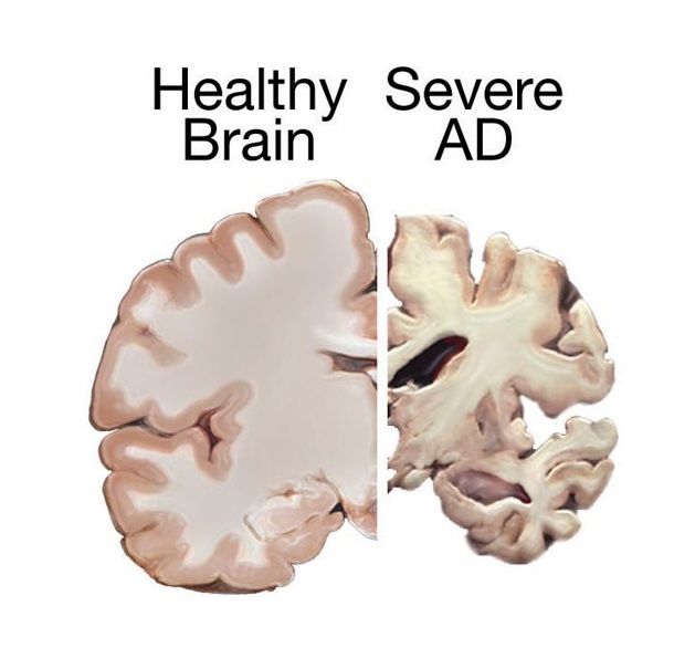 Alzheimers Brain 9721